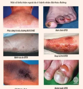 biến chứng tiểu đường giai đoạn cuối​