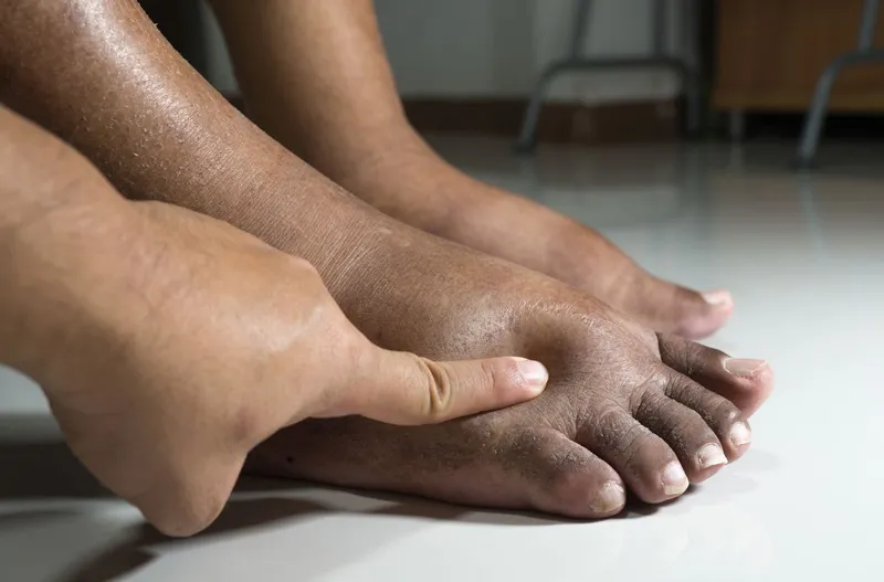 Nguyên Nhân Và Dấu Hiệu Hoại Tử Chân Do Tiểu Đường