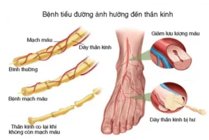 hoại tử chân do tiểu đường​