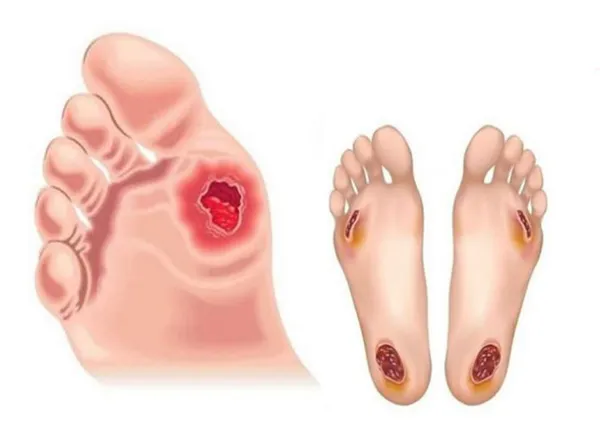 Phòng Ngừa Hoại Tử Chân Do Tiểu Đường