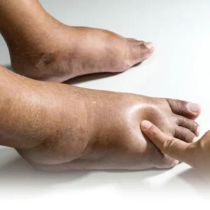 người bệnh tiểu đường bị phù chân​